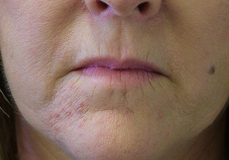 lip lines1 before juvederm