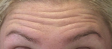 forehead-before-botox-raising-brows