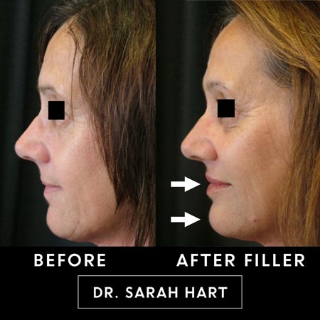 Before and after shots of filler