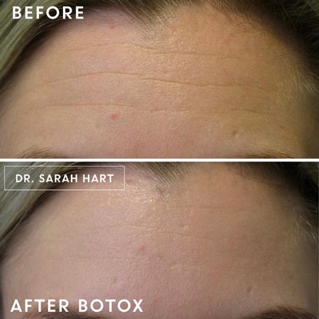 Forehead wrinkles before and after botox