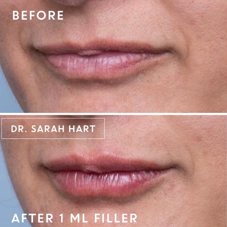 female patient's lips before and after a dermal filler
