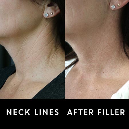 Neck lines before and after filler