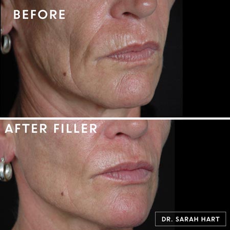 Before and after Jawline filler