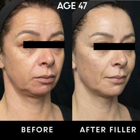 47 year old woman before and after Botox