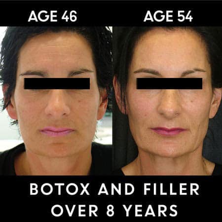 Botox results over 8 years