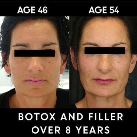 Botox filler results on woman over 8 years
