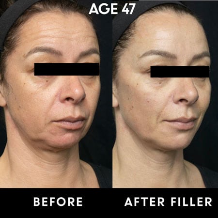 47 year old patient before and after cheek filler